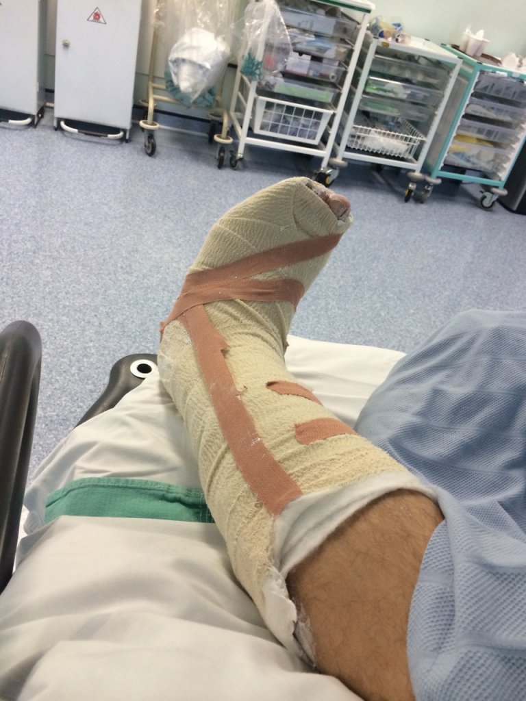 Leg in plaster cast