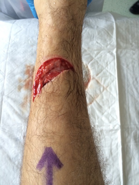 Leg Injury