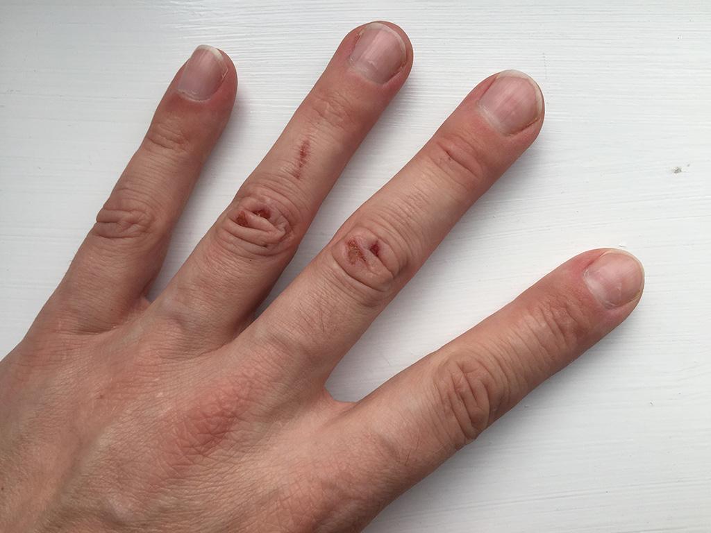 Grazed knuckles